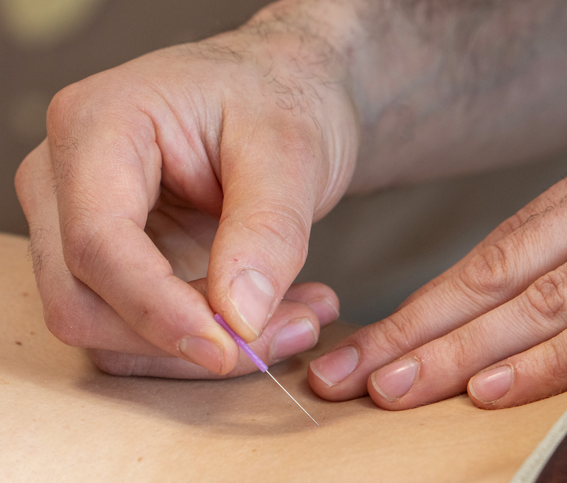 Hoe bereid je je cliënten voor op een dry needling behandeling?
