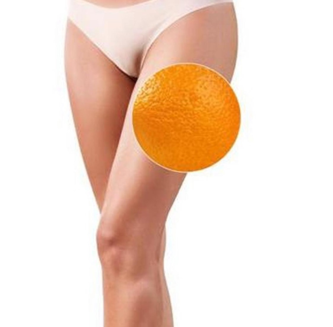 Cellulitis behandelen en verminderen