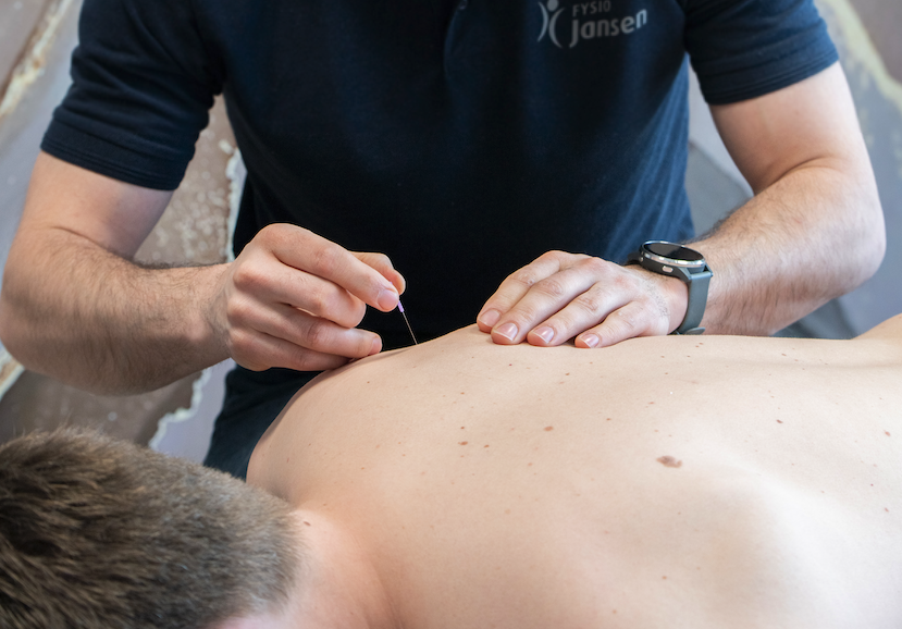Dry needling naalden